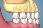 Cracked Root Canal Root and Bone Loss